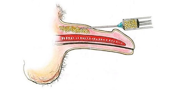 Injekcije hijaluronske kiseline u bačvu člana kako bi je povećali